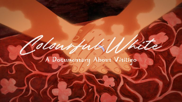 Spots et force: naviguer dans la vie avec vitiligo