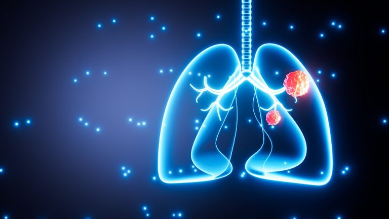 L&rsquo;étude relie la pollution de l&rsquo;air à plus de mutations de cancer du poumon chez les non-fumeurs