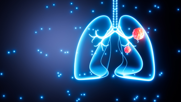 Jusqu&rsquo;à 1 patient sur 5 atteint d&rsquo;un cancer du poumon est non-fumeur : étude