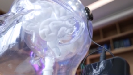 Un BCI implantable développé par Neuracle Medical Technology. /Groupe de médias chinois